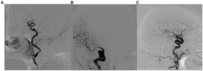 Aspiration thrombectomy versus stent retriever thrombectomy as a first-line approach for cardiogenic cerebral embolism and cryptogenic stroke in large vessels of the anterior circulation